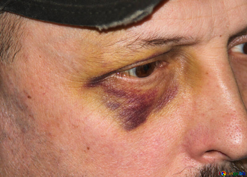 Bruise  and  eye №8621